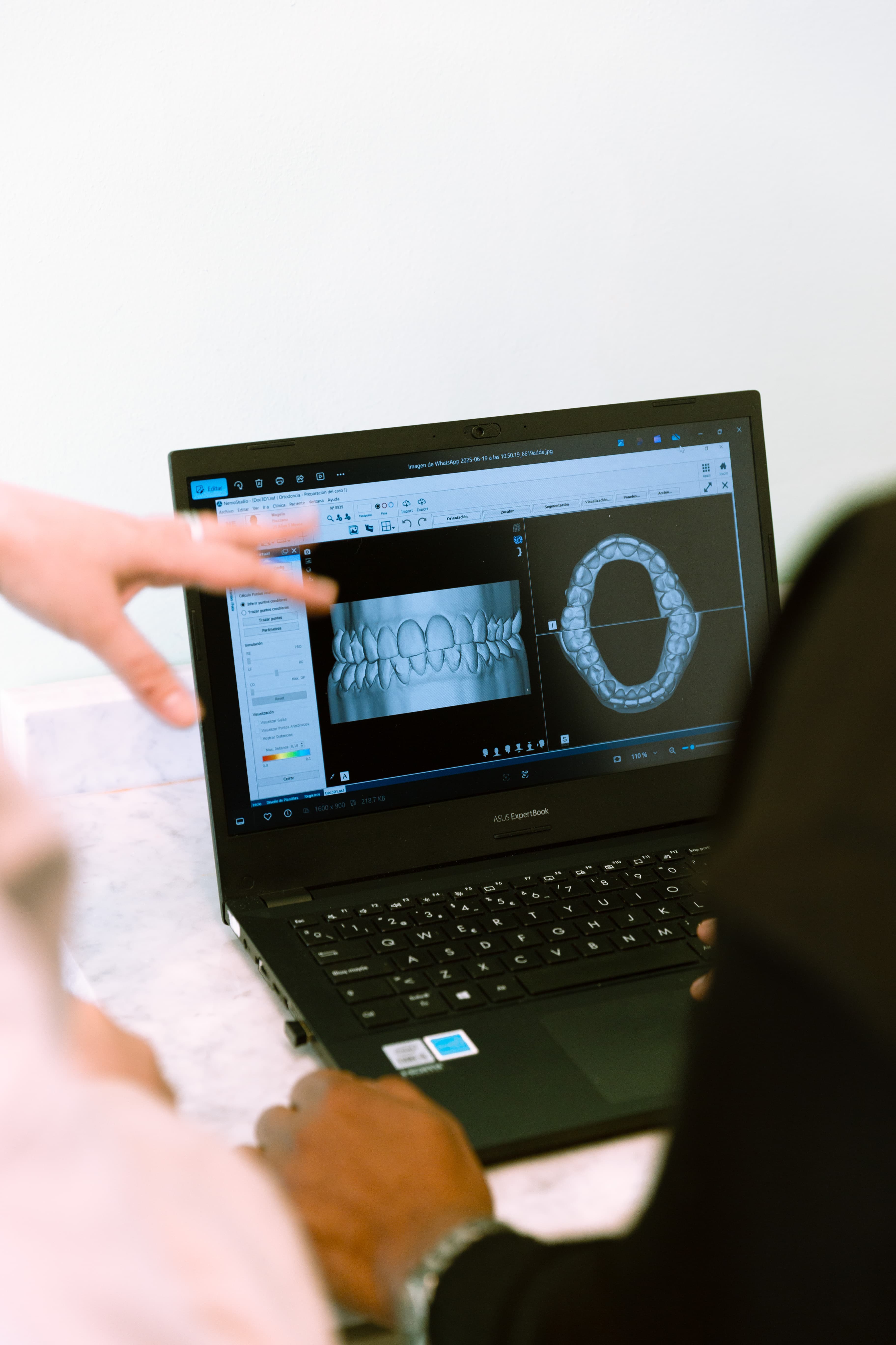 Alineadores dentales — tratamiento dental personalizado